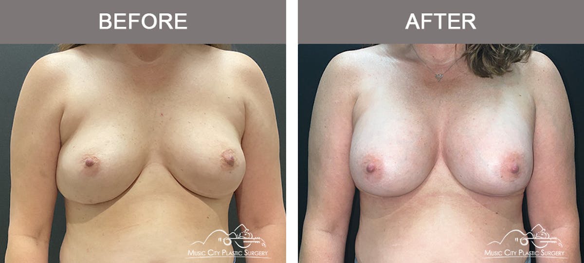 Implant Exchange Before & After Gallery - Patient 390810 - Image 1