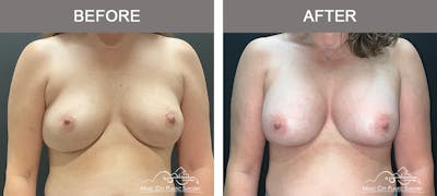 Implant Exchange Before & After Gallery - Patient 390810 - Image 1