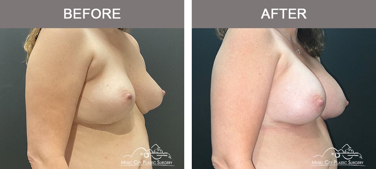 Implant Exchange Before & After Gallery - Patient 390810 - Image 2