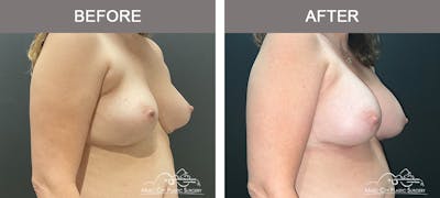 Implant Exchange Before & After Gallery - Patient 390810 - Image 2