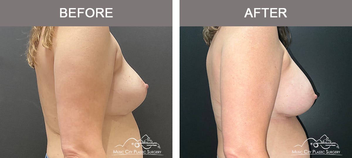 Implant Exchange Before & After Gallery - Patient 390810 - Image 3