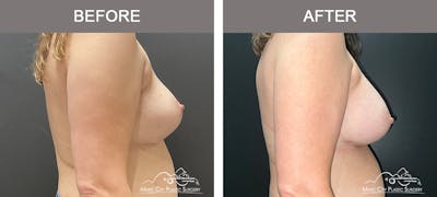 Implant Exchange Before & After Gallery - Patient 390810 - Image 3