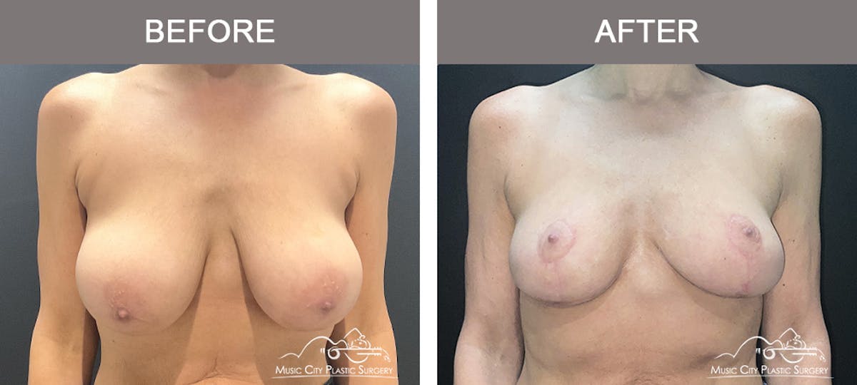 Breast Reduction Before & After Gallery - Patient 197528 - Image 1