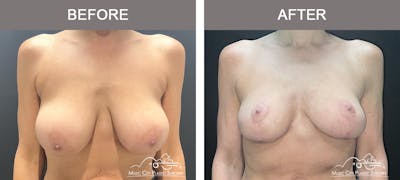 Breast Reduction Before & After Gallery - Patient 197528 - Image 1