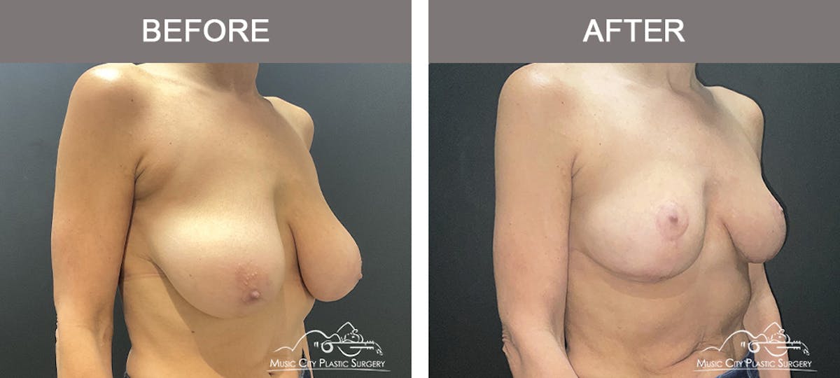 Breast Reduction Before & After Gallery - Patient 197528 - Image 2