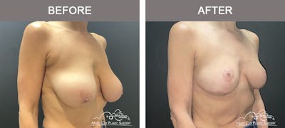 Breast Reduction Before & After Gallery - Patient 197528 - Image 2