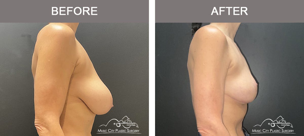 Breast Reduction Before & After Gallery - Patient 197528 - Image 3