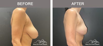 Breast Reduction Before & After Gallery - Patient 197528 - Image 3