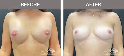 Breast Reduction Before & After Gallery - Patient 157742 - Image 1
