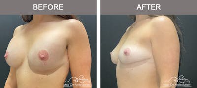Breast Reduction Before & After Gallery - Patient 157742 - Image 2