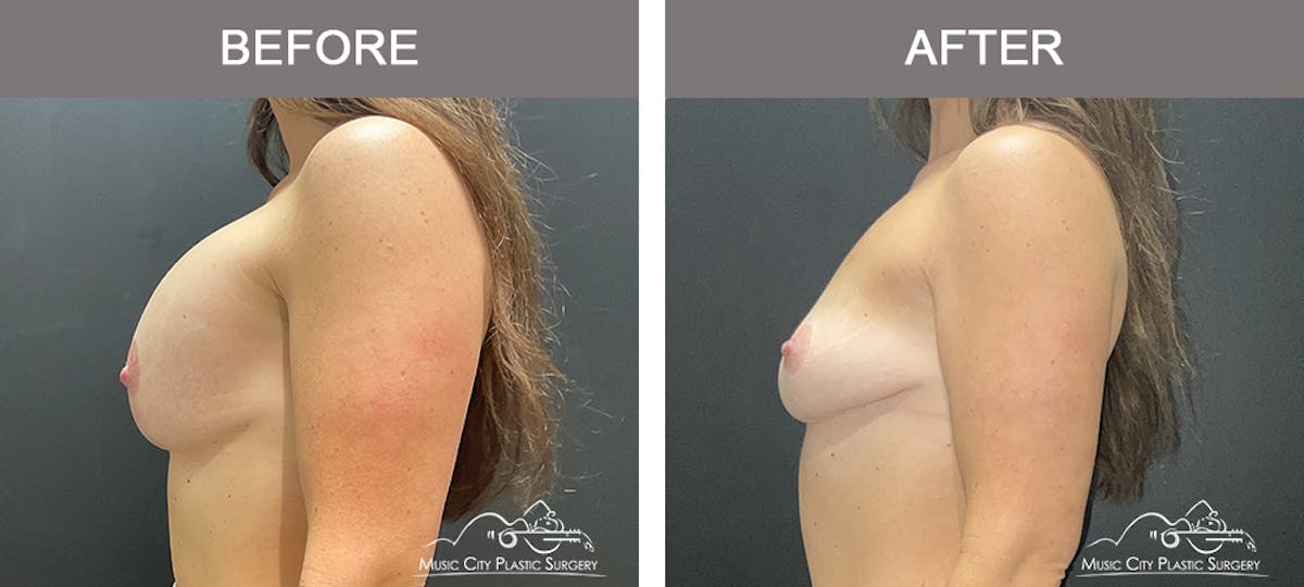 Breast Reduction Before & After Gallery - Patient 157742 - Image 3