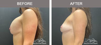 Breast Reduction Before & After Gallery - Patient 157742 - Image 3