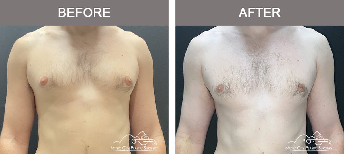 Gynecomastia Before & After Gallery - Patient 685216 - Image 1
