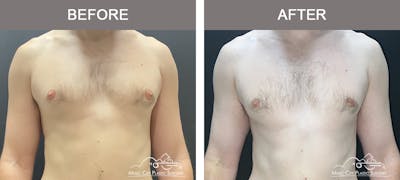 Gynecomastia Before & After Gallery - Patient 685216 - Image 1