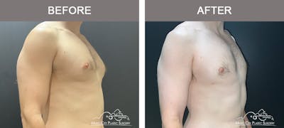 Gynecomastia Before & After Gallery - Patient 685216 - Image 2