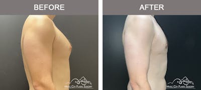 Gynecomastia Before & After Gallery - Patient 685216 - Image 3