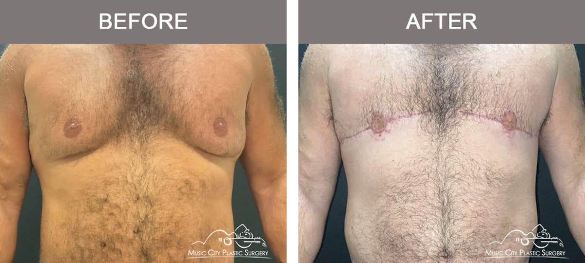 Gynecomastia Before & After Gallery - Patient 247575 - Image 1
