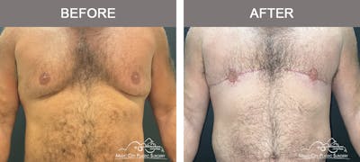 Gynecomastia Before & After Gallery - Patient 247575 - Image 1