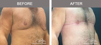 Gynecomastia Before & After Gallery - Patient 247575 - Image 2