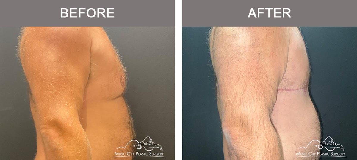 Gynecomastia Before & After Gallery - Patient 247575 - Image 3