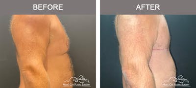Gynecomastia Before & After Gallery - Patient 247575 - Image 3