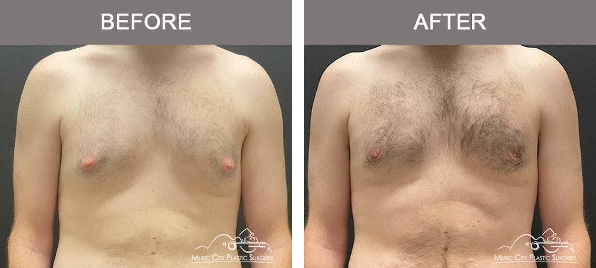 Gynecomastia Before & After Gallery - Patient 260741 - Image 1