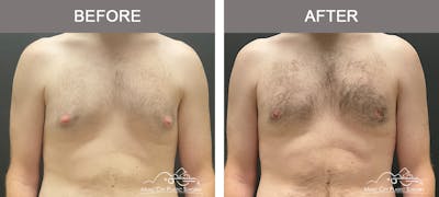 Gynecomastia Before & After Gallery - Patient 260741 - Image 1
