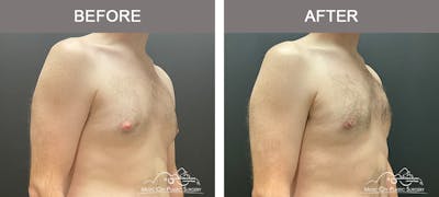 Gynecomastia Before & After Gallery - Patient 260741 - Image 2
