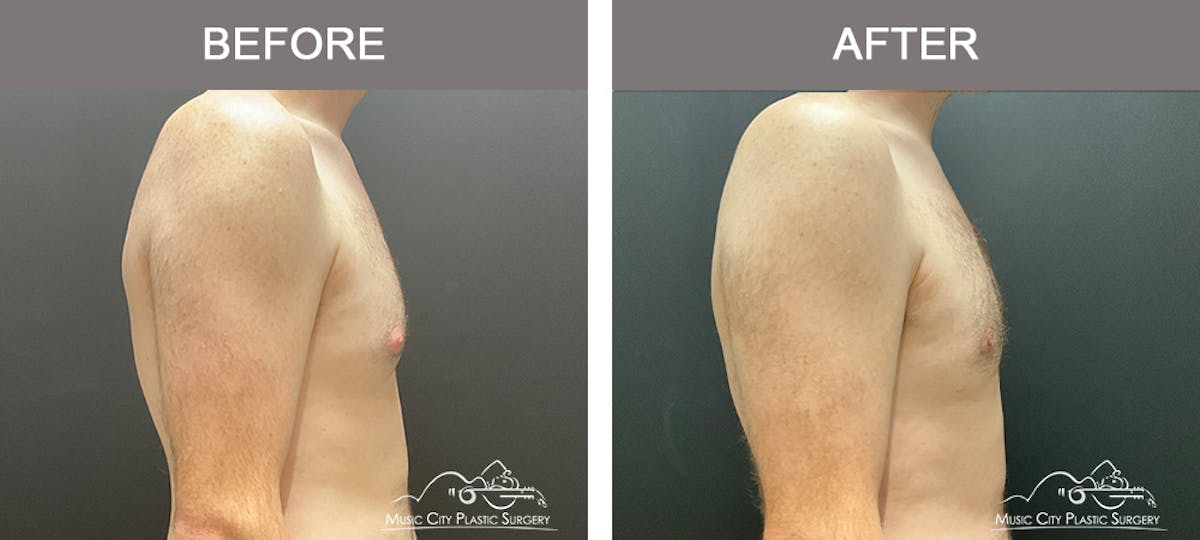 Gynecomastia Before & After Gallery - Patient 260741 - Image 3