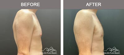 Gynecomastia Before & After Gallery - Patient 260741 - Image 3