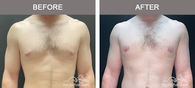 Gynecomastia Before & After Gallery - Patient 325945 - Image 1