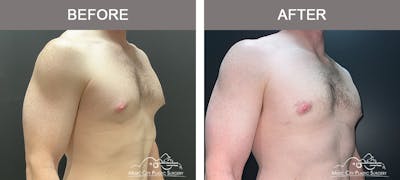 Gynecomastia Before & After Gallery - Patient 325945 - Image 2
