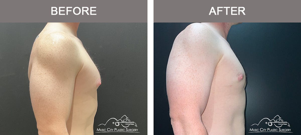 Gynecomastia Before & After Gallery - Patient 325945 - Image 3