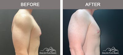 Gynecomastia Before & After Gallery - Patient 325945 - Image 3