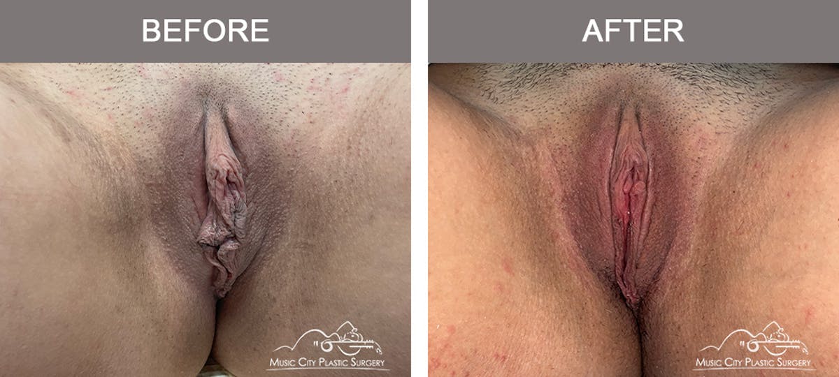 Labiaplasty Before & After Gallery - Patient 294861 - Image 1