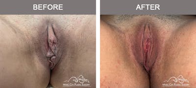 Labiaplasty Before & After Gallery - Patient 294861 - Image 1