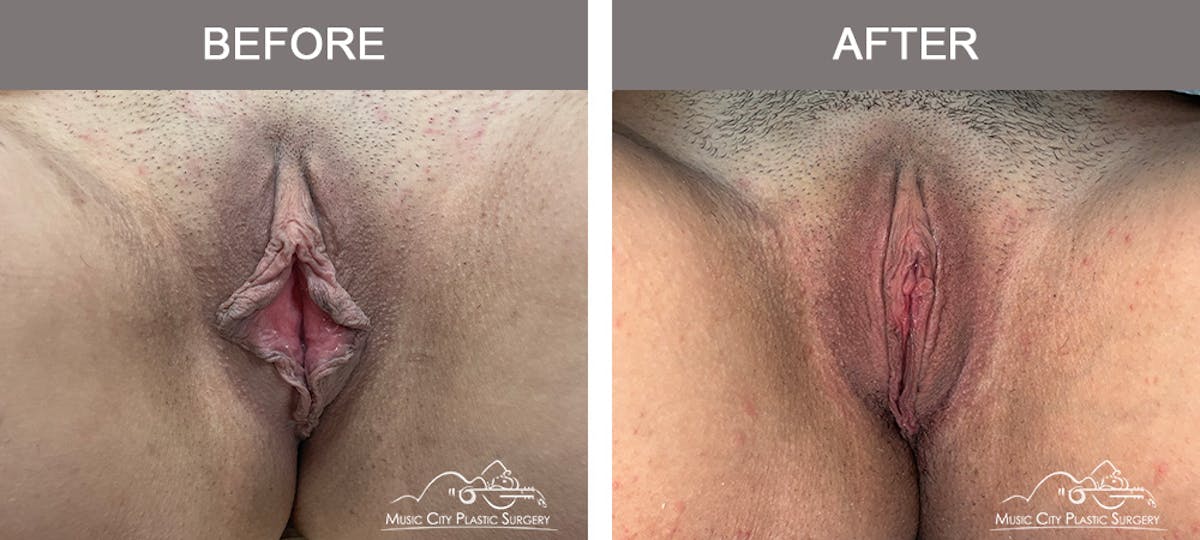 Labiaplasty Before & After Gallery - Patient 294861 - Image 2