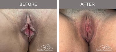 Labiaplasty Before & After Gallery - Patient 294861 - Image 2