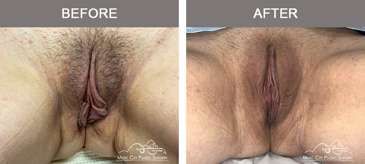 Labiaplasty Before & After Gallery - Patient 374370 - Image 1