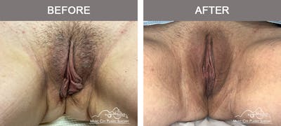 Labiaplasty Before & After Gallery - Patient 374370 - Image 1