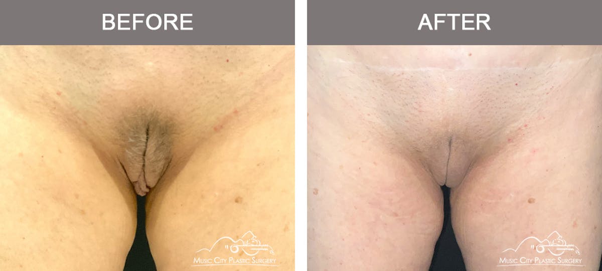 Labiaplasty Before & After Gallery - Patient 374370 - Image 2