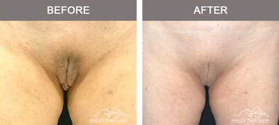 Labiaplasty Before & After Gallery - Patient 374370 - Image 2