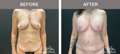 Liposuction Before & After Gallery - Patient 304354 - Image 1