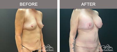 Liposuction Before & After Gallery - Patient 304354 - Image 2