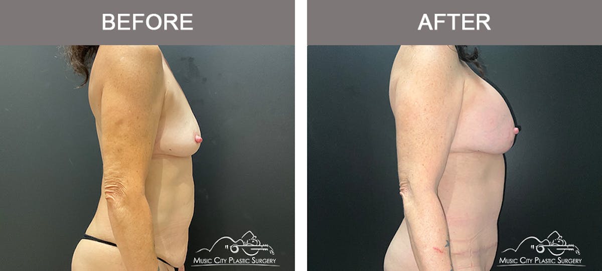 Liposuction Before & After Gallery - Patient 304354 - Image 3