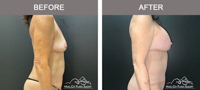 Liposuction Before & After Gallery - Patient 304354 - Image 3