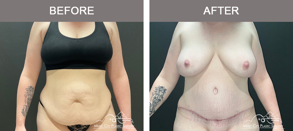 Liposuction Before & After Gallery - Patient 124877 - Image 1