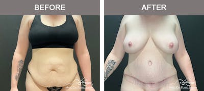 Liposuction Before & After Gallery - Patient 124877 - Image 1