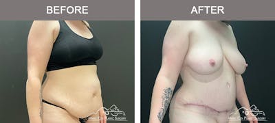 Liposuction Before & After Gallery - Patient 124877 - Image 2