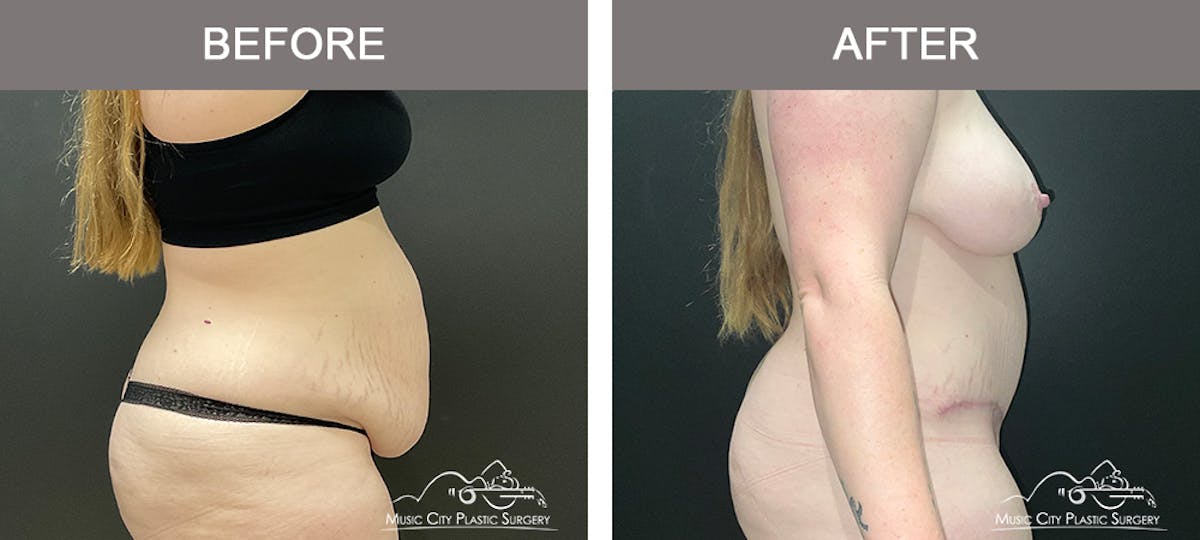 Liposuction Before & After Gallery - Patient 124877 - Image 3
